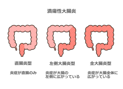 潰瘍性大腸炎