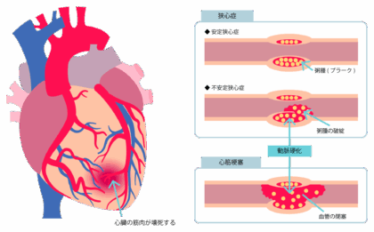 狭⼼症・⼼筋梗塞