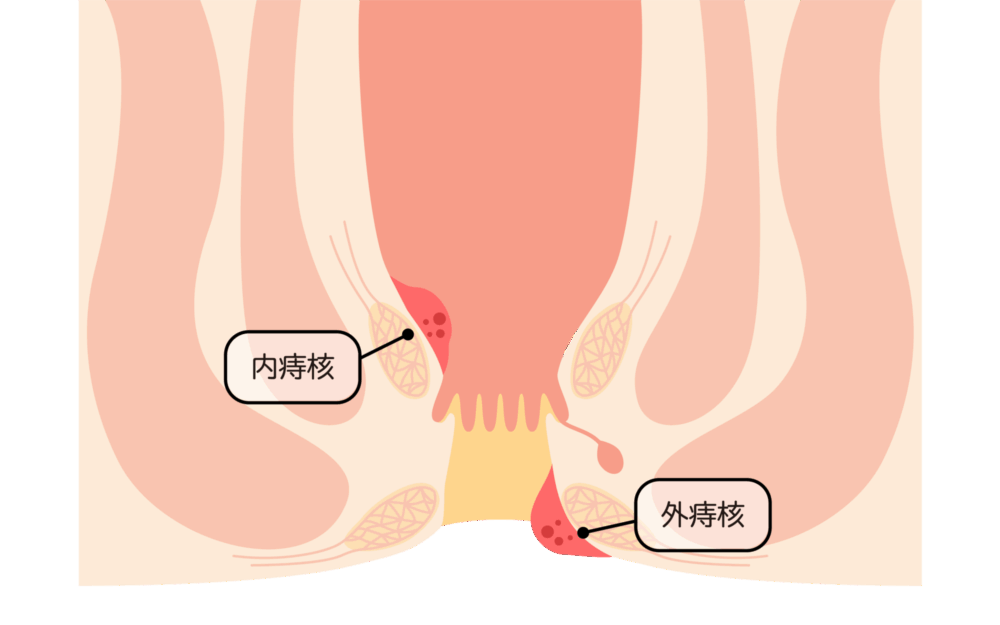 いぼ痔（痔核）