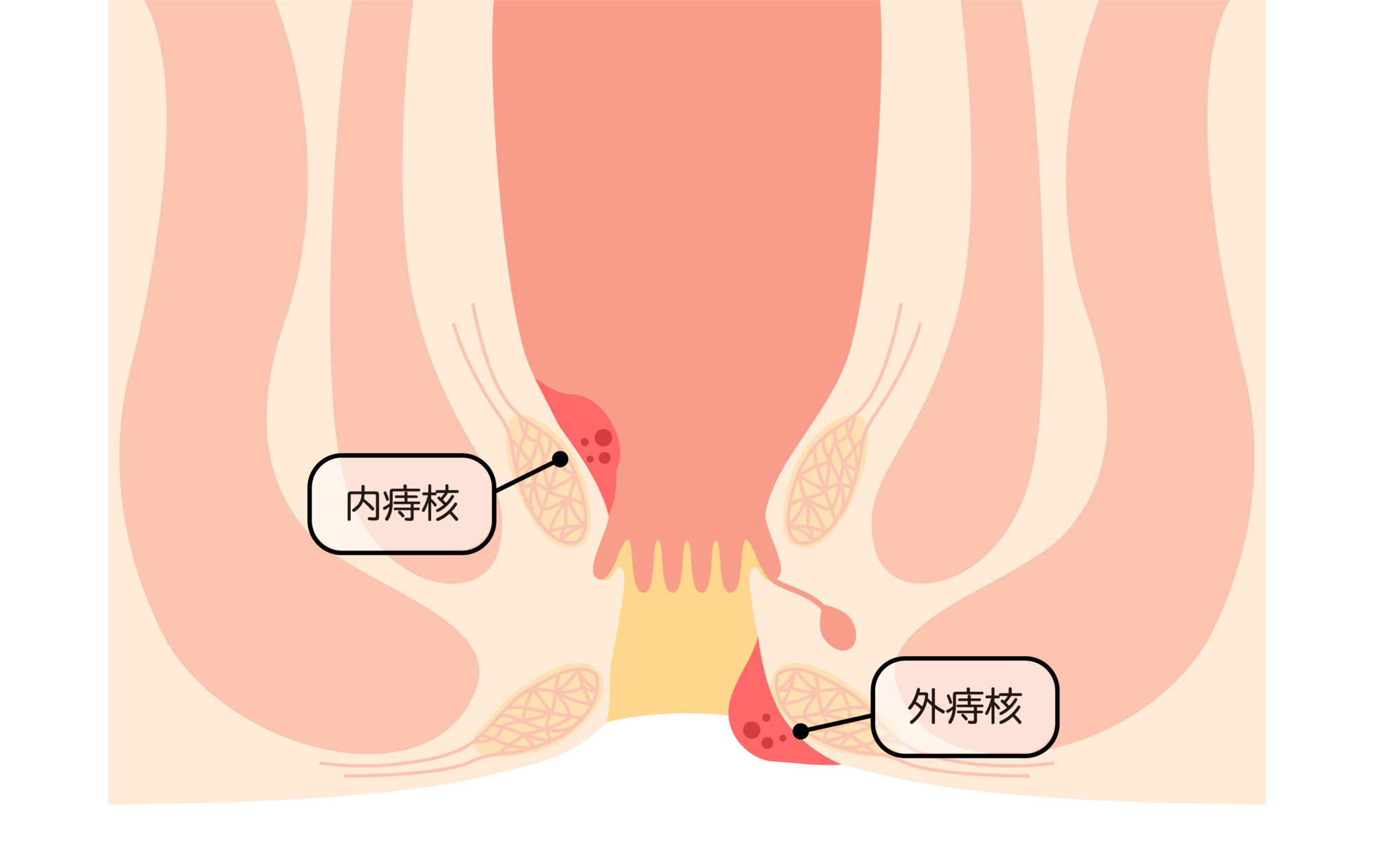いぼ痔について