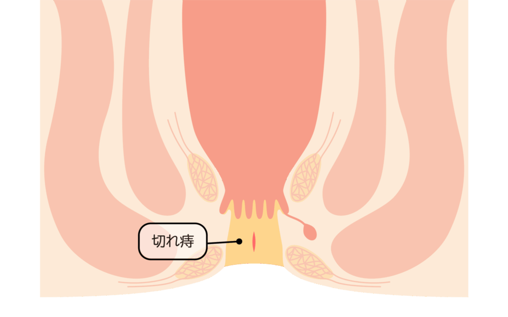 切れ痔