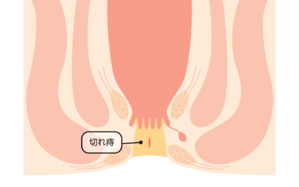 切れ痔