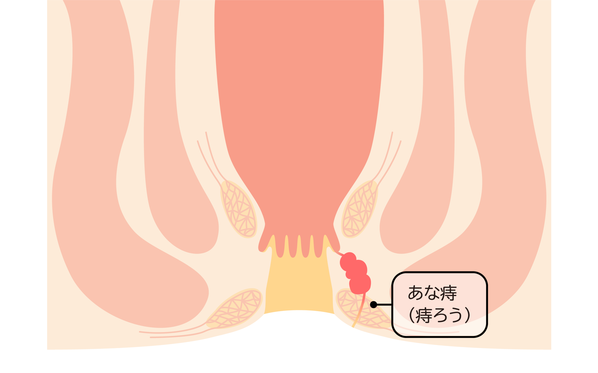 痔ろう（痔瘻）とは