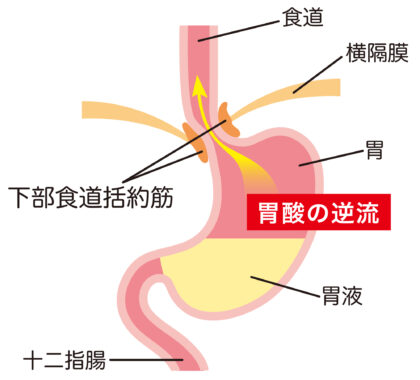 逆流性食道炎とは？ストレスが原因？