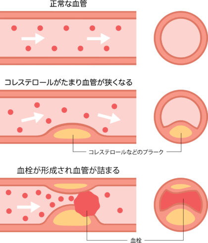 閉塞性動脈硬化症とは