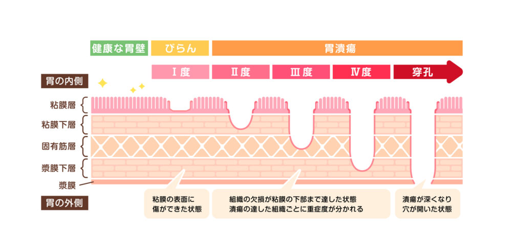 胃潰瘍とは