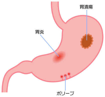 胃炎とは