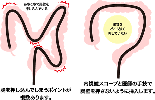 負担の少ない軸保持短縮法